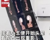 26岁男子因背30斤重背包引发脑梗：警惕颈椎病的严重性