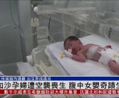 5月大女婴腹中取出罕见寄生胎，医学界震惊